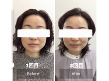 堺整骨院 小郡院/小顔矯正