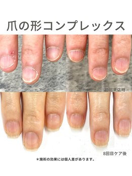 30代/爪の形コンプレックス