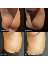 ビトタン 倉敷本店(+美to鍛)/レモンボトル3cc