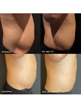 ビトタン 倉敷本店(+美to鍛)/レモンボトル3cc