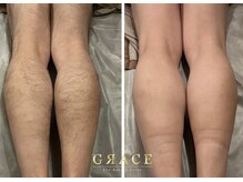 グレイス 久留米店(GRACE)の雰囲気（施術1回→2週間後。男性の濃い毛でも自信があります☆）