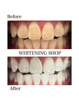 ホワイトニングショップ 銀座7丁目店(WHITENING SHOP)/Before After
