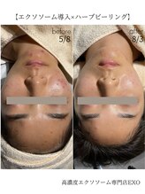 エクソ 吉祥寺(EXO)/3ヶ月で驚きの変化！！