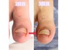 【足の悩み/変形爪/爪の変色/厚い爪/様子が変な爪】変形爪のケア3回目