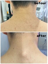 ワイズサロン(Y's salon)/メンズうなじ脱毛