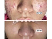 ミラビューティー(Mira Beauty)/ニキビ肌改善