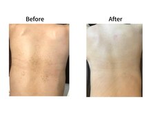 エミルカ(EMILUCA)/ハーブピーリングでお悩み改善