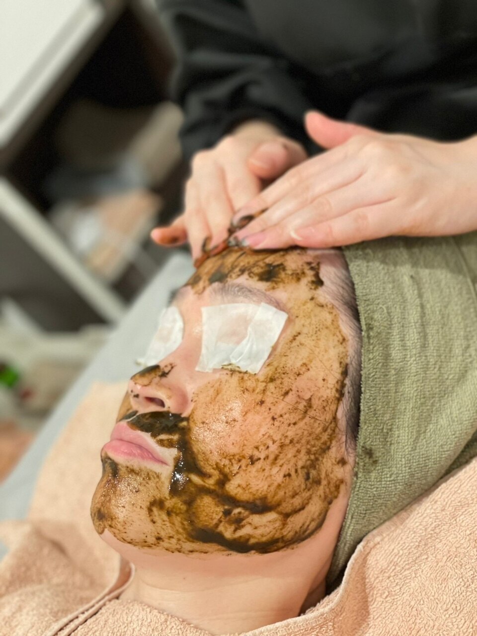 【ナークハーブピーリング +アフターケアのプラズマ +水素】剥離あり