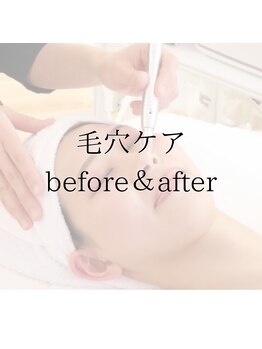 プラセル(Placer)/