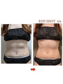 サロン ド 花歩 松山本店/Wキャビ＋レッドショット施術1回