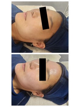 フローラル ビューティー(Floral-Beauty)/韓国☆『スーパージェクション』