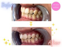 エクシアホワイト 広島袋町店/ホワイトニングビフォーアフター