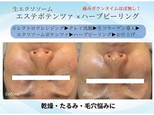 エイミー(Aimee)/高濃度エクソソーム