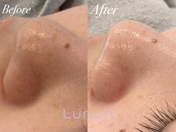 ルノン(Lunon)/毛穴洗浄ハイドロ