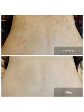 エミルカ(EMILUCA)/ハーブピーリングでお悩み改善