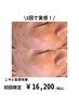 【ニキビ肌質改善】ハーブピーリング&最新光フェイシャル　