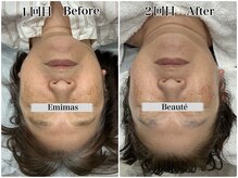 エミマス ボーテ(Emimas Beaute’)/５０代　毛穴洗浄＆幹細胞２回目