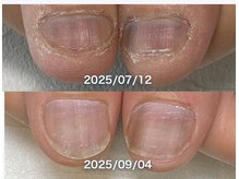 ポメロ(POMELO)/わずか2ヶ月、爪周りの肌も整う