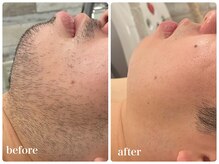 エリクサー 加須店(Elixir)/ヒゲ脱毛8回照射後before after!