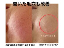 エイチケービューティーサロン(H/K beauty salon)/【開いた毛穴も！】