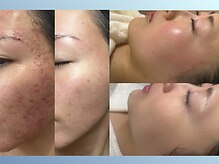リヴィア(LIVIA)の雰囲気（ニキビ・敏感肌の肌質改善が得意なサロン【福山市】）