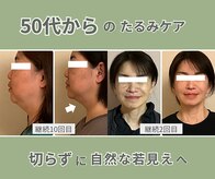 ベルソー(Berceau)