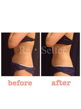 ラ セルフィー(Ra Selfee)/パルス痩身マグブレイク症例