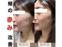 ブルーシー(BLUESEA)/【RHR】幹細胞ハーブピーリング