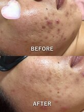 エシャーム(echarme)/ニキビケア