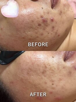 エシャーム(echarme)/ニキビケア