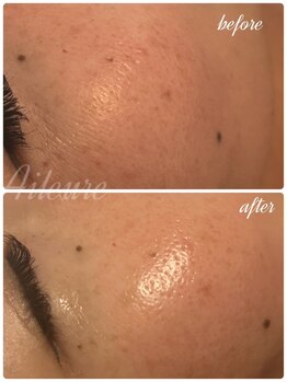 エルール トータルビューティ(Aileure total beauty)/最新ピーリング　ララピール