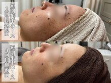 サロンノワ(salon noix)/《ニキビケアの次はシミケア》