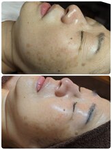 ウララ(ulala)/ララピール＋シミケア