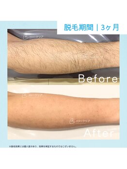 メンズクリア 静岡店/【メンズクリア】お客様の施術例