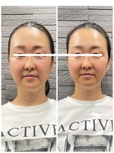 長寿鍼灸院 長寿整骨院/美容鍼25本の効果★小顔効果