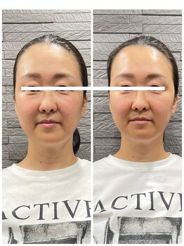 長寿鍼灸院 長寿整骨院/美容鍼25本の効果★小顔効果