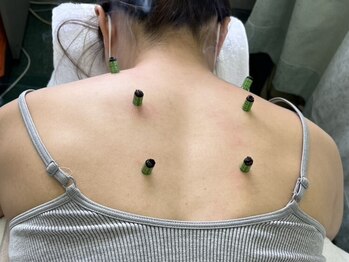 原田針灸整骨院の写真/お灸って熱い？もぐさの香り◎お客様のお悩みに沿った内容で施術可能！首肩こり、腰痛、全身の疲労改善に！