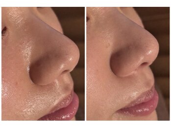 ボヌールデソワ(Bonheur de Soi)/ハーブピーリング/毛穴/透明感