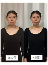 エクラ(eclat)/120分コース4回施術