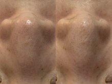 TEN Aesthetic【艶肌・肌質改善・五臓漢方よもぎ蒸し】【7/2　NEW　OPEN（予定）】/TEN Aestheticの毛穴ケアの効果