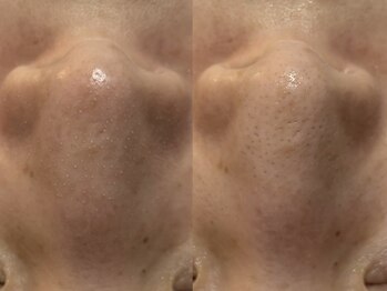 TEN Aesthetic【艶肌・肌質改善・五臓漢方よもぎ蒸し】【7/2　NEW　OPEN（予定）】/TEN Aestheticの毛穴ケアの効果