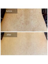 エミルカ(EMILUCA)/ハーブピーリングでお悩み改善