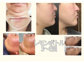 リジュベネーションサロン アリス(Alice)/レモンボトルＢ＆Ａ