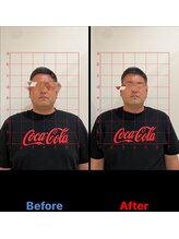 カルミア鍼灸接骨院/男性美容鍼ビフォーアフター