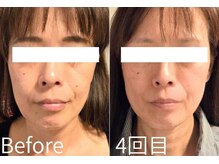 藍/レモンボトル×プラズマ