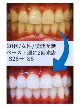 スマイルホワイト 練馬店/ホワイトニングBeforeAfter