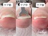 【巻爪ケア◎親指1本】根本ケアで辛くない巻爪補正・ネイルトリム対応¥9,980
