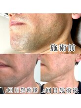 ハル(Halu)/メンズヒゲ脱毛