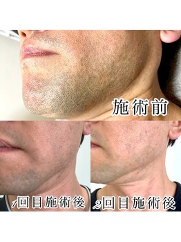 ハル(Halu)/メンズヒゲ脱毛