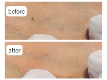 カシェット(Cachette)/30代女性 シミケア5スポット